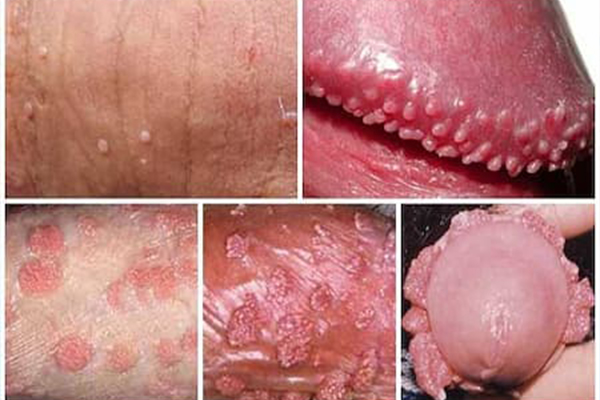 Các triệu chứng sùi mào gà nam giới