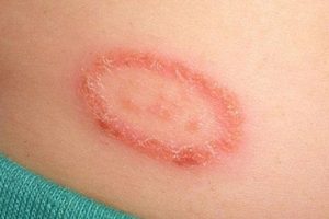 Hắc lào có lây không? Bệnh lây qua đường nào?
