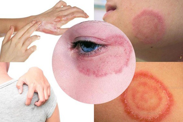 Bị hắc lào kiêng gì nhanh khỏi?