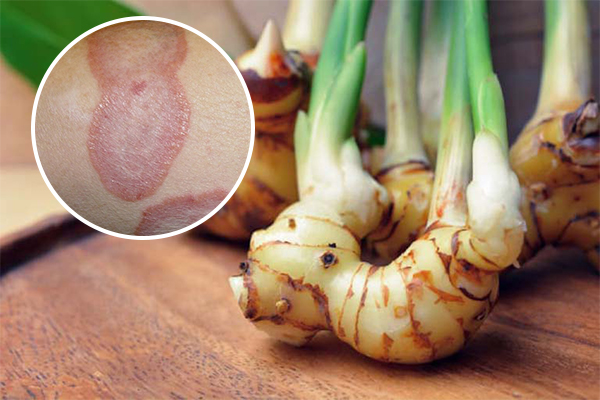 Chữa bệnh hắc lào bằng củ riềng có hiệu quả không?